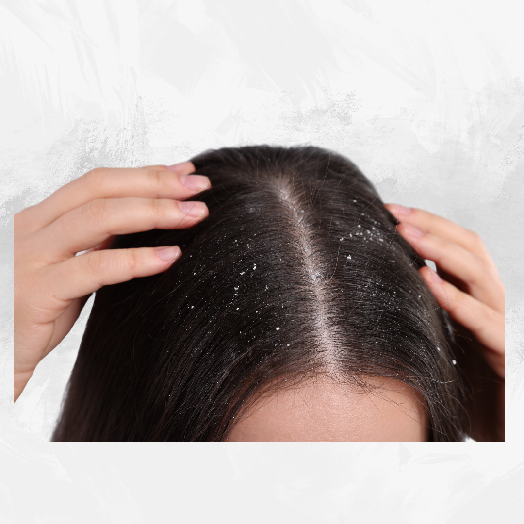 ANTI FORFORA E CUTE SENSIBILE.